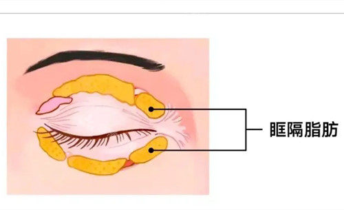 眼周眶隔脂肪卡通示意圖 眼周眶隔脂肪卡通示意圖