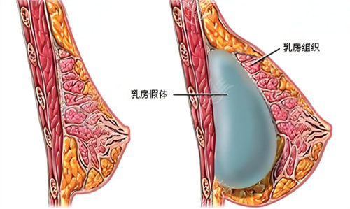 假体隆胸术原理图 假体隆胸术原理图