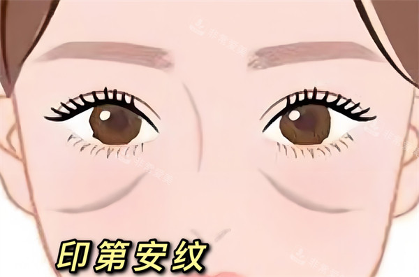 印第安紋位置圖 印第安紋位置圖
