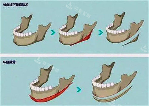 不同下颌骨结构方式对比图