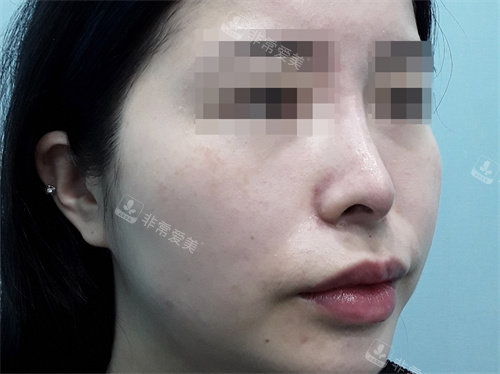 韓國BIOFACE皮膚科玻尿酸隆鼻前圖片 韓國BIOFACE皮膚科玻尿酸隆鼻前圖片