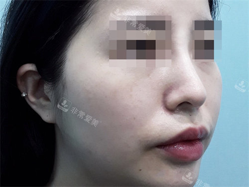 韓國BIOFACE皮膚科玻尿酸隆鼻后圖片 韓國BIOFACE皮膚科玻尿酸隆鼻后圖片