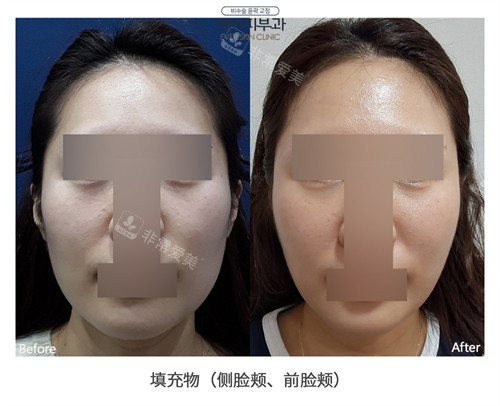 韓國ever皮膚科面部填充前后對比圖 韓國ever皮膚科面部填充前后對比圖