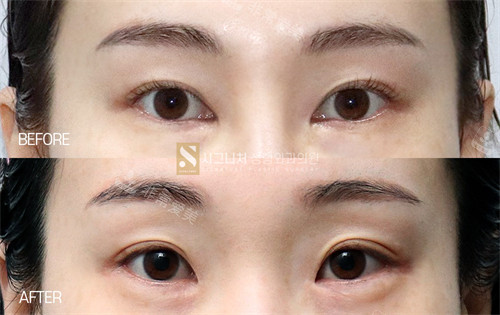 韓國signature整形外科內(nèi)眼角修復前后對比圖 韓國signature整形外科內(nèi)眼角修復前后對比圖