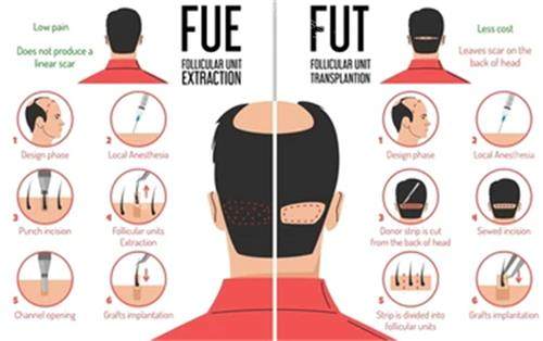 不同植发技术对比图解