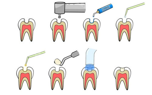 补牙步骤