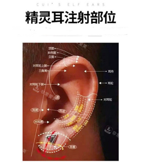 精靈耳注射部位 精靈耳注射部位