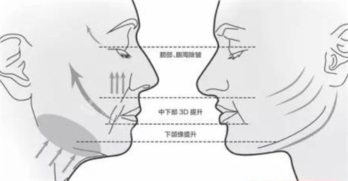 韩国Titanium钛提升成效如何？我在韩国皮肤科尝试了一下真的拥有小V脸了~