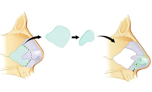 假体隆鼻简易过程示意图