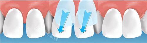 门牙贴面过程