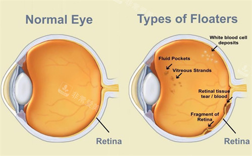 正常眼睛和飞蚊症眼睛的不同