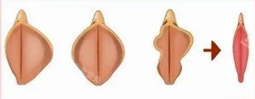 阴唇整形前后对比图