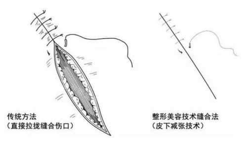 超减张精细缝合和传统缝合的区别图片