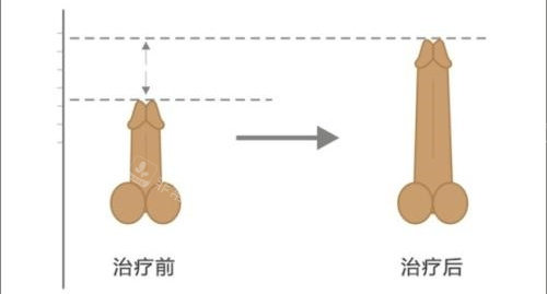 阴茎增长手术前后长度对比动画图