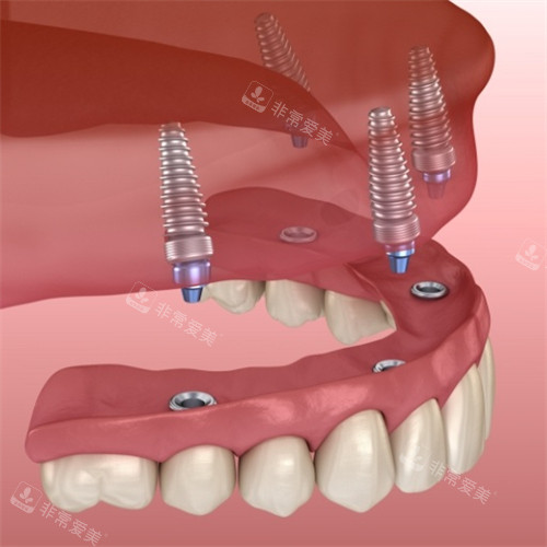 半口种植牙图示 (2)