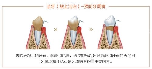 洗牙龈上洁治过程示意图