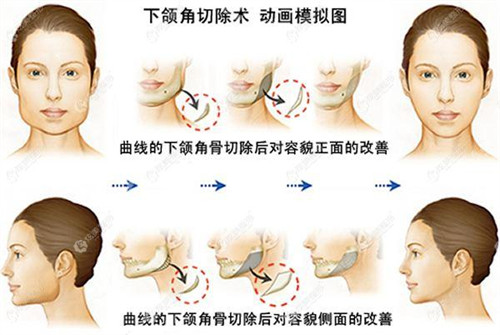 下颌角切除术动画模拟图