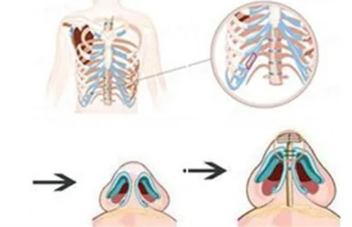 肋骨鼻手術(shù)過程