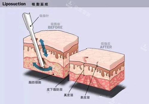 想知道韩国做吸脂手术怎么样那你需要来看一下我的吸脂经历！