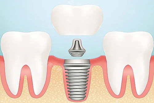 口腔种植牙卡通示意图