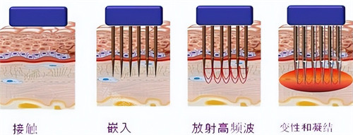 黄金微针操作过程