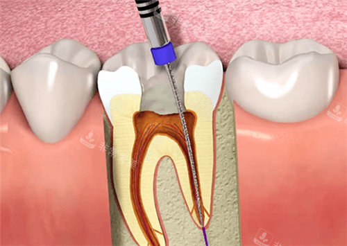 牙齿根管治填充