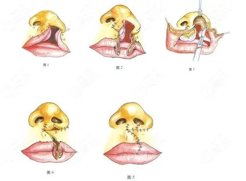 唇腭裂修復(fù)過(guò)程簡(jiǎn)易卡通示意圖