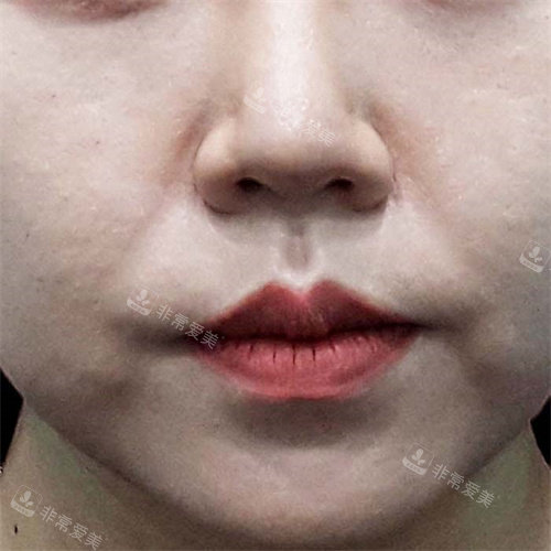 韓國BIOFACE皮膚科去法令紋前 韓國BIOFACE皮膚科去法令紋前