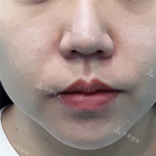 韓國BIOFACE皮膚科去法令紋后 韓國BIOFACE皮膚科去法令紋后