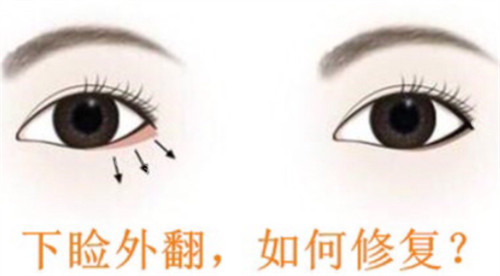 下眼瞼外翻怎么辦 下眼瞼外翻怎么辦