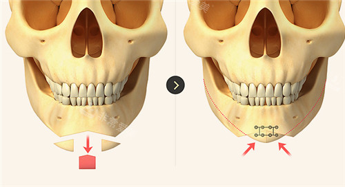 下巴整形環(huán)骨骼變化圖