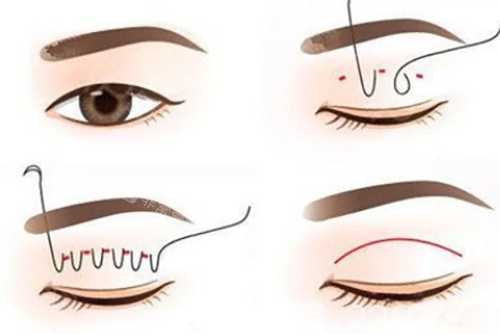韩国医生推荐用什么术式割双眼皮?看看我去三家出名的整形外科医生给我出具的方案!
