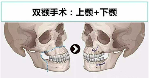 双鄂手术