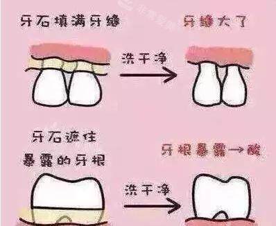 洗牙洁牙后症状漫画图