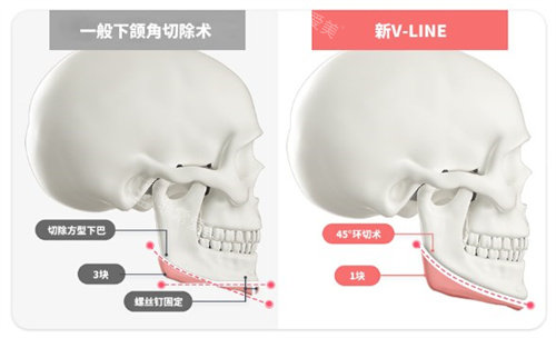 新V-LINE手術(shù)