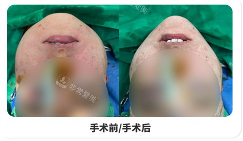 下頜角手術(shù)前后對(duì)比 下頜角手術(shù)前后對(duì)比