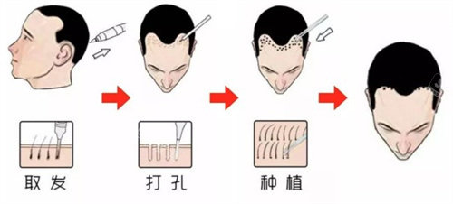 植發(fā)過(guò)程