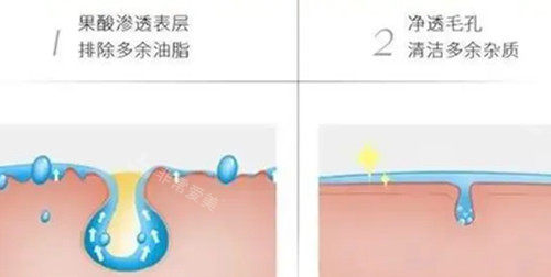 果酸焕肤步骤示意图