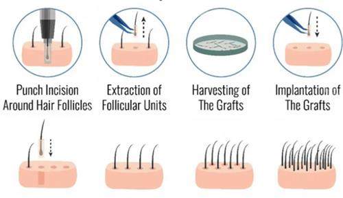 毛發(fā)移植過程圖解