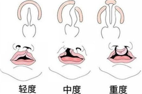 唇腭裂按不同程度划分