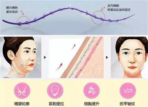 面部埋線提升前后對比圖 面部埋線提升前后對比圖