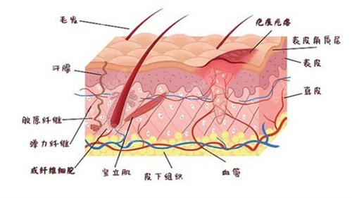 疤痕增生原理