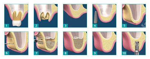 牙科植骨步骤照片