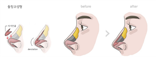 韩国自体肋鼻修复的真实经历,在国内修复多次的鼻子终于在韩国修复好了!