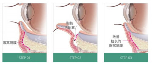 眼底脂肪重排術