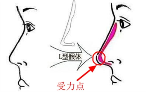L形隆鼻假体对比 L形隆鼻假体对比
