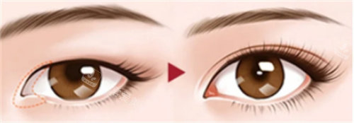 開內(nèi)眼角術(shù)圖 開內(nèi)眼角術(shù)圖