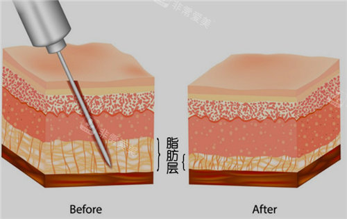 吸脂前后对比照