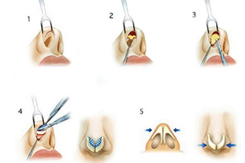 鼻头整形示意图1