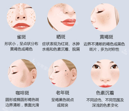 不同斑點(diǎn)類型 不同斑點(diǎn)類型